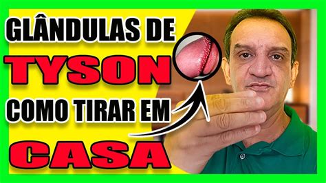 glandulas tyson o que é|Glândulas de Tyson: o que são, porque aparecem e tratamento